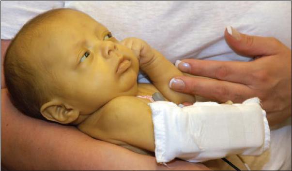 Jaundarbības simptoms jaundzimušajiem: hepatīta veidi un pazīmes